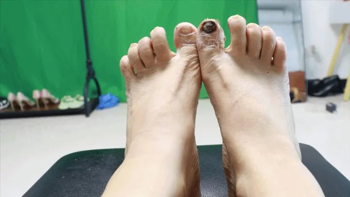 Gts Asia Vr World - 4K ERER Onychomycosis